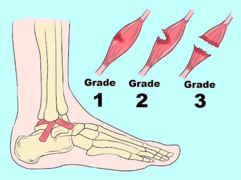 Phương pháp an toàn và hiệu quả để điều trị khi bị lật cổ chân
